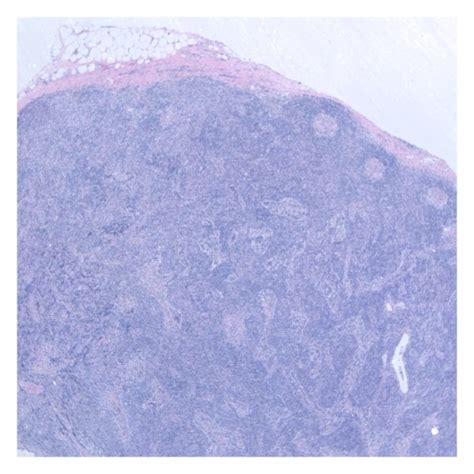 Biopsy Of Left Axillary Lymph Node Demonstrating A Well Developed