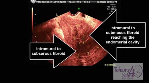 Gynecology Ultrasound Multiple Fibroid Uterus Youtube