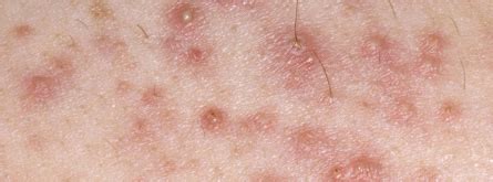 Over time, a bump, usually just one, may. how do i get rid of these little cyst thingies around my ...