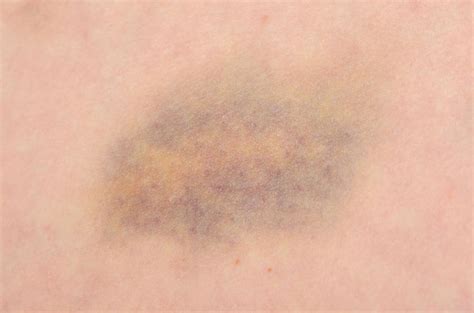 What Is A Groin Hematoma With Pictures