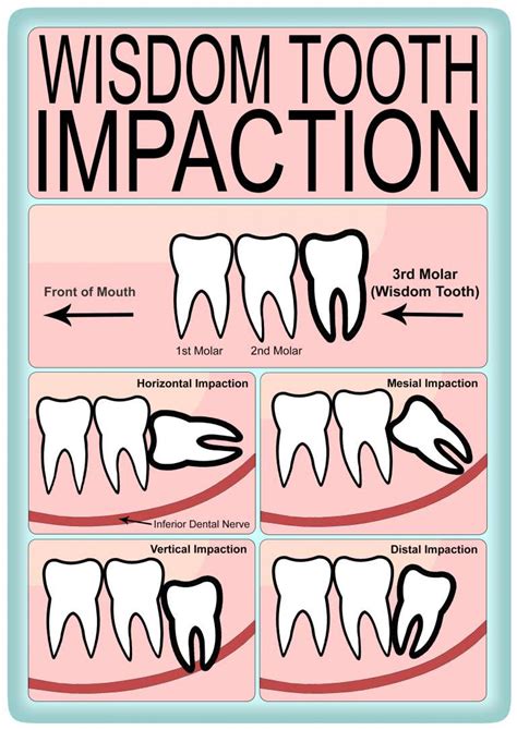 What Are The Different Kinds Of Wisdom Tooth Impaction Greenlife Dental