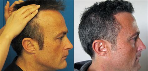 Who Is Goodbest At Restoring Temple Points Hair Restoration