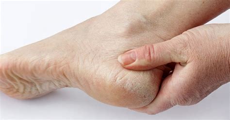 Psoriasis On The Toes What Causes It And The Way Is It Handled