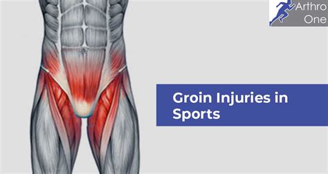 Groin Injuries In Sports Arthro One