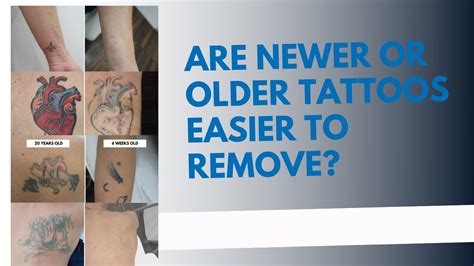 Are Newer Or Older Tattoos Easier To Remove Youtube
