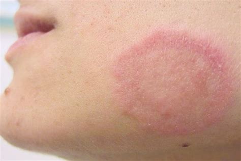 Ringworm is not only an unsightly skin condition, it is often unbearable for those who suffer from it. How To Get Rid of Ringworms? 25 Effective Home Remedies To Look Into