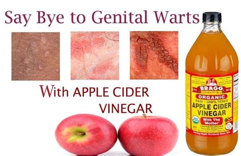 How To Get Rid Of Genital Warts Fast With Apple Cider Vinegar Cure Yourself