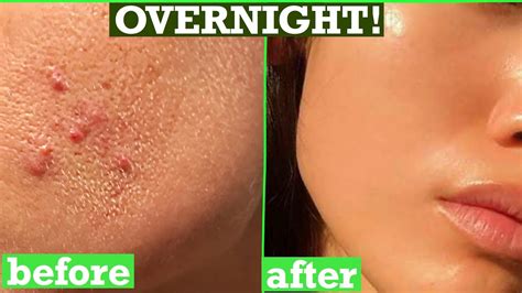Real Life Experience How To Get Rid Of Little Bumps On Face Overnight