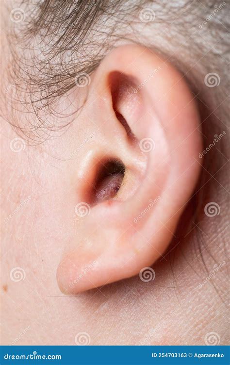 Close Up Of Abscess Inflammation On The Ear Area Of Suppuration Ear