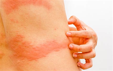 Whats That Rash On Your Body 5 Common Types Explained Skin Rash