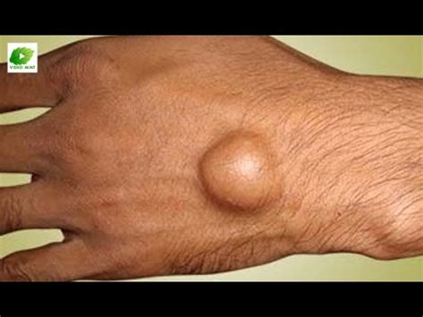 We did not find results for: How to Dissolve Ganglion - Calcium Deposits - YouTube