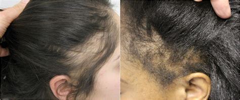 Tackling Traction Alopecia Hair Restoration Europe