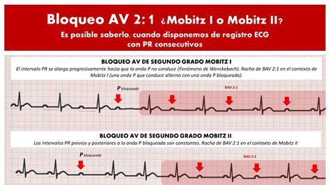 Cardiotruco Bloqueos Av Cardioprimaria Ferrol