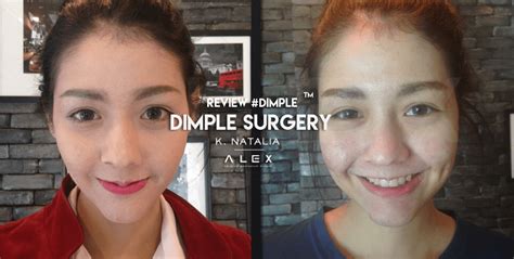 Dimple Surgery Dralex