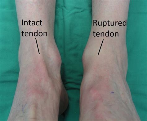 Treatment Of Acute And Chronic Tibialis Anterior Tendon Rupture And