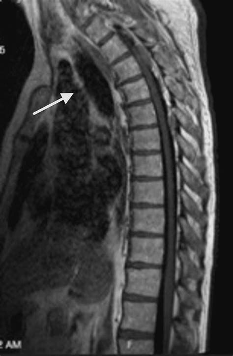 MRI Thoracic Spine W Wo Contrast Showing An Epidural Hematoma Extending Download Scientific