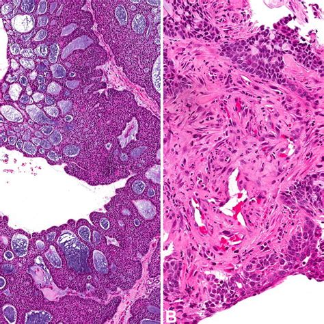 adenoid cystic carcinoma with squamous differentiation and variant download scientific diagram