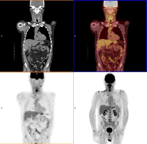 New Pet Ct Scans Track Down Persistent Cancer Cells Medical Design