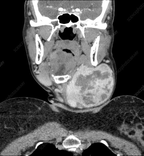 Large Thyroid Goiter Ct Stock Image C0365228 Science Photo Library