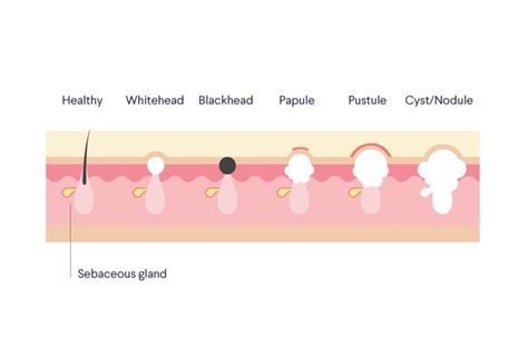 Types Of Acne Blackheads Whiteheads Fungal Cysts More