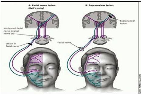 Bell's palsy is a peripheral nerve effect whereas a ischemic stroke is a central process. Past papers of Dentistry FCPS Part 1 | Dentistry & Medicine