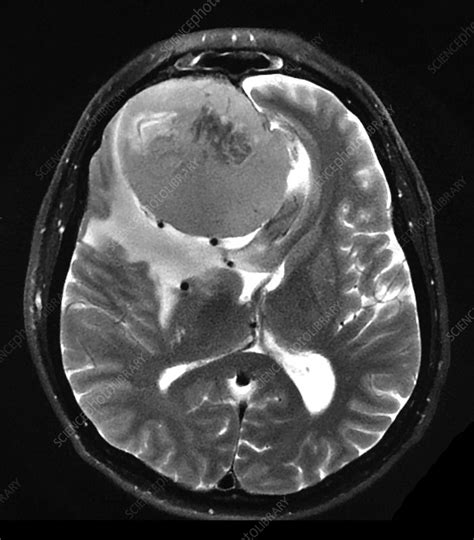 Large Frontal Meningioma Mri Stock Image C0393903 Science Photo