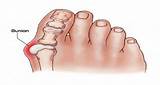 How Do Doctors Remove Bunions Pictures