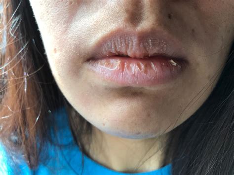 Why Wont My Lips Stop Peeling Puchong Ian 蒲种人