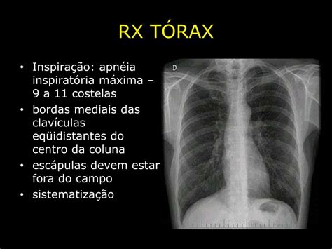 PPT RX TÓRAX PowerPoint Presentation free download ID 5950500