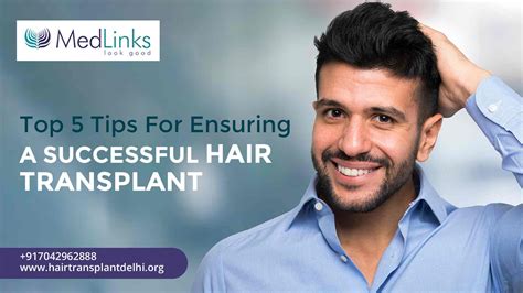 Top 5 Tips For Ensuring A Successful Hair Transplant