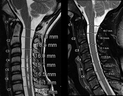 Sagittal T2 Weighted Mr Images Trte 3000100 Ms In 2 Patients
