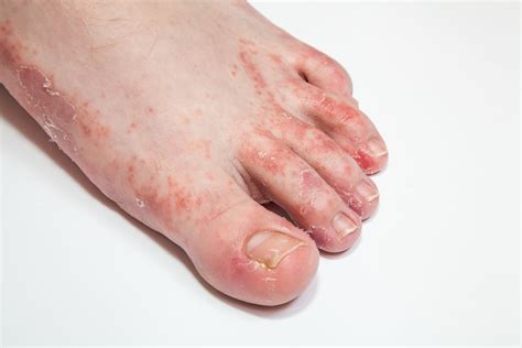 Over The Counter Options For Foot Dermatoses