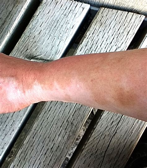 Vitiligo Facts Skin Pigment Loss And Possible Treatments Youmemindbody