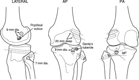 Posterolateral Knee Reconstruction Musculoskeletal Key