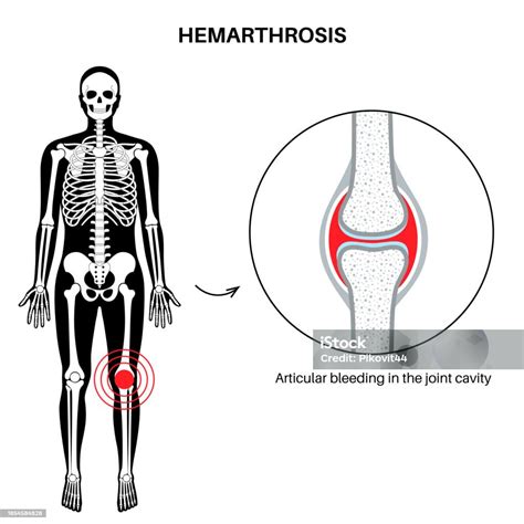 Hemarthrosis In The Synovial Joint Stock Illustration Download Image