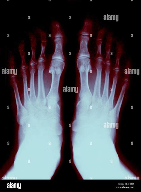 Foot Fingers Exposed On The X Ray Stock Photo Alamy