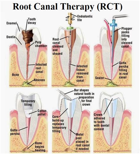 Root Canal Treatment Endodontic Treatment Explained News Dentagama