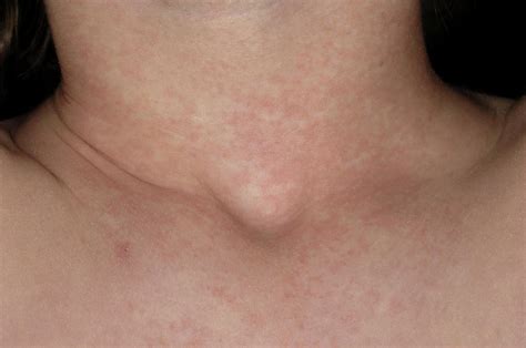 Scarlet Fever Rash Photograph By Dr P Marazzi Science Photo Library