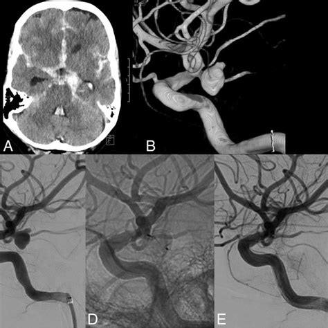 A 57 Year Old Woman With A Ruptured Anterior Communicating Artery
