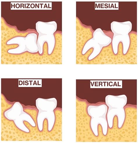 Painless Wisdom Tooth Extraction Singapore Dental Clinic