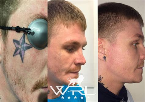 Top 150 Laser Before And After Tattoo Monersathe