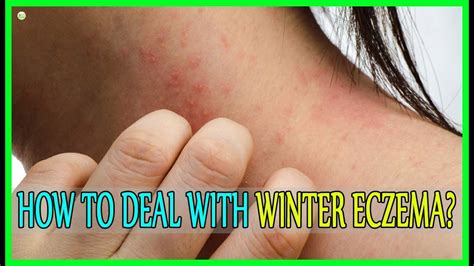 How To Deal With Winter Eczema How To Stop Eczema Itching Best