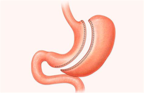 Sleeve Gastrectomy Linked To High Prevalence Of Barrett Esophagus