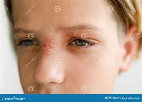 Large Red Rash On The Nose And Over The Child S Eye Dermatolonia