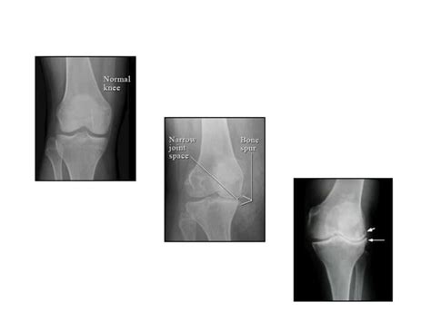 Osteoarthritis Knee Ppt