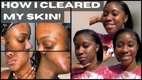 My Accutaneisotretinoin Journey Part 1 How I Cleared My Skin Youtube