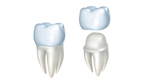 Zahn überkronen bedeutet, dem ruinierten zahn eine neue krone aufsetzen. Zahnkronen - Alle Infos zu Kosten und Ablauf