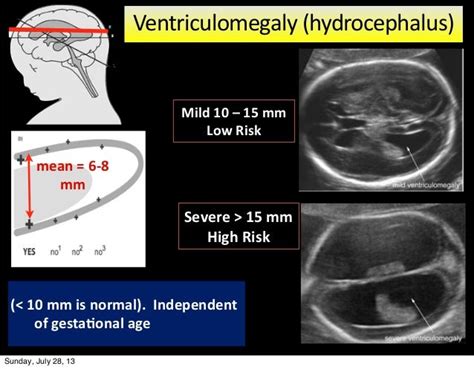 Fetal Neurosonogram