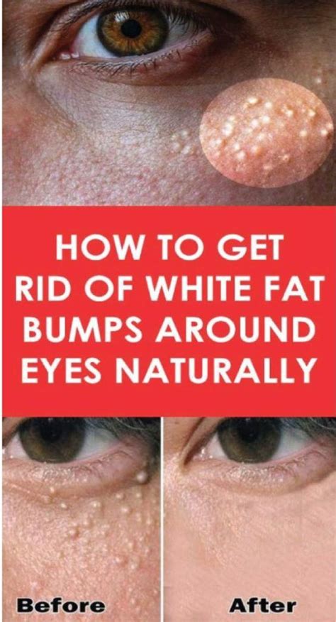 Cryotherapy is the most frequently recommended way. +MILIA: HOW TO REMOVE THE SMALL WHITE SKIN CYSTS? in 2020 ...