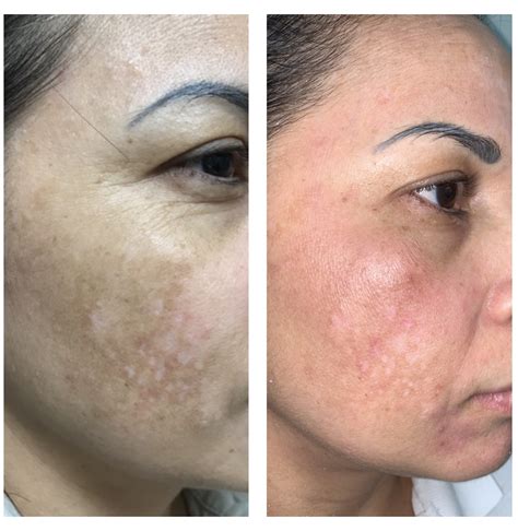 Hyper Pigmentation Treatment Before And After